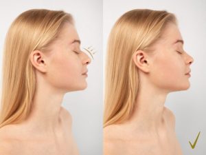 Read more about the article مراحل تغير الأنف بعد عملية التجميل بالصور تطور مذهل خطوة بخطوة