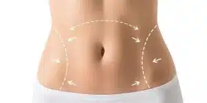 شد ترهلات البطن بدون جراحة