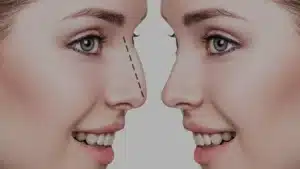 Read more about the article عملية تجميل الانف بالتفصيل من الاستشارة إلى النتائج النهاية