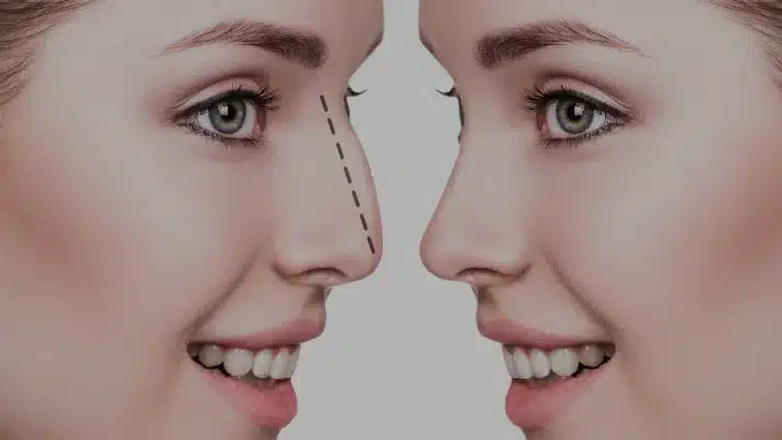 Read more about the article عملية تجميل الانف بالتفصيل من الاستشارة إلى النتائج النهاية
