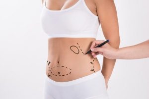 عملية شفط الدهون من البطن
