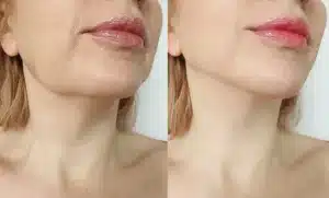 قبل وبعد عملية شد الوجه