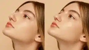 عملية تجميل الانف قبل وبعد
