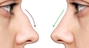 عملية تجميل الأنف قبل وبعد بالصور