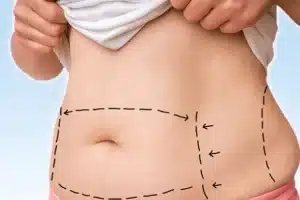 تجربتي مع شفط الدهون بالفيزر