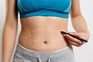 ما هو شفط الدهون بدون جراحة