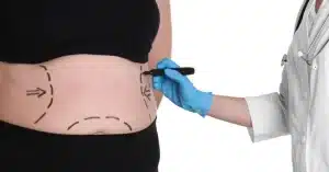 ما هي عملية شد البطن