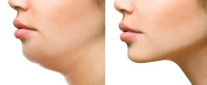 You are currently viewing متى تظهر نتيجة شفط اللغلوغ؟ | أفضل نتائج مع د. وليد الجبالي