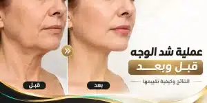 عملية شد الوجه قبل وبعد: النتائج ومتى تظهر وكيف تقيّم الصور
