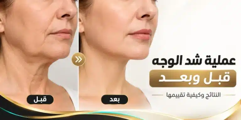 Read more about the article عملية شد الوجه قبل وبعد: النتائج ومتى تظهر وكيف تقيّم الصور