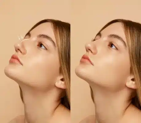 woman-getting-ready-nose-job-surgery_23-2149487567-ezgif.com-jpg-to-webp-converter