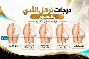 درجات ترهل الثدي بالصور: كيف تعرفين درجتك والعلاج المناسب؟