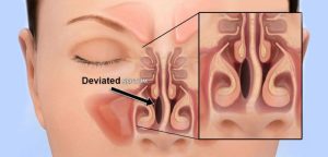 Read more about the article هل انحراف الحاجز الأنفي يسبب ضيق تنفس: تعرف مع أفضل دكتور تجميل