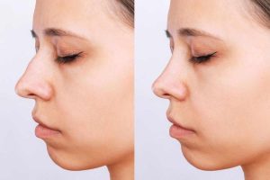 Read more about the article عمليات تجميل الانف قبل وبعد شاهد مع دكتور وليد الجبالي