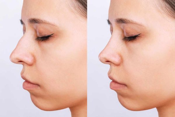 Read more about the article عمليات تجميل الانف قبل وبعد شاهد مع دكتور وليد الجبالي