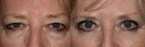 You are currently viewing عملية شد الجفون بالصور مع الدكتور وليد الجبالي: النتائج الطبيعية والأمان التام