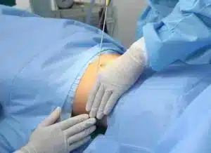 بالصور-عملية-شفط-الدهون-300x218.jpg