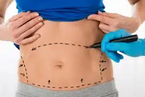 Read more about the article بالصور عملية شفط الدهون مع الدكتور وليد الجبالي: النتائج الطبيعية والجسم المتناسق