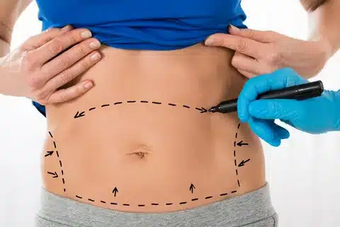 Read more about the article بالصور عملية شفط الدهون مع الدكتور وليد الجبالي: النتائج الطبيعية والجسم المتناسق