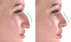 عملية تجميل الأنف: الخطوات والتخدير والتعافي والنتائج