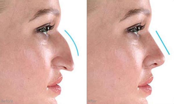 Read more about the article عملية تجميل الأنف: الخطوات والتخدير والتعافي والنتائج